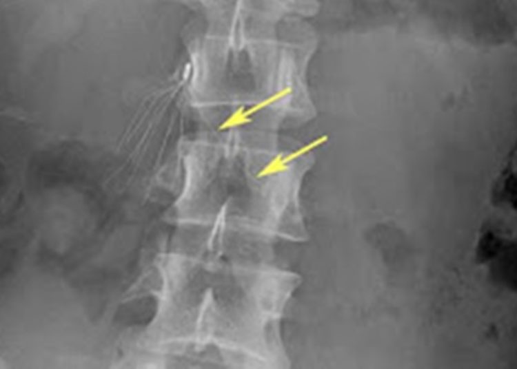 Quick Take: A multicenter trial of vena cava filters in severely injured patients