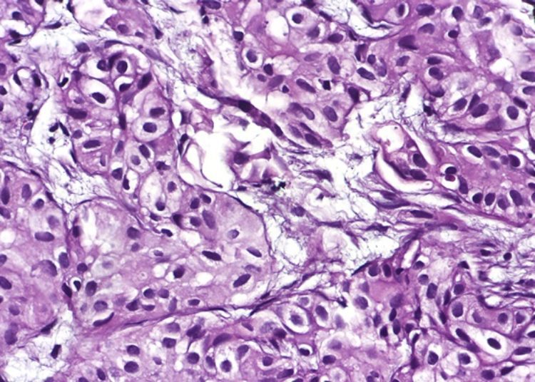 Quick Take: Erdafitinib in locally advanced or metastatic urothelial carcinoma