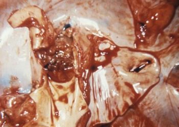 FDG-PET scanning demonstrates prognostic significance in prosthetic valve infective endocarditis