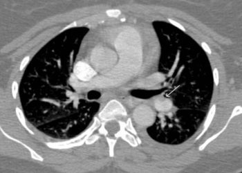 Quick Take: Hospital volume and outcomes for acute pulmonary embolism