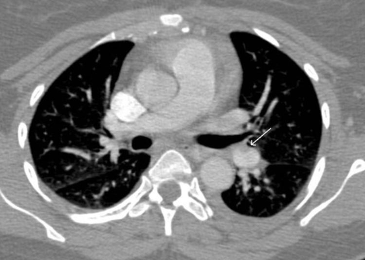 Quick Take: Hospital volume and outcomes for acute pulmonary embolism