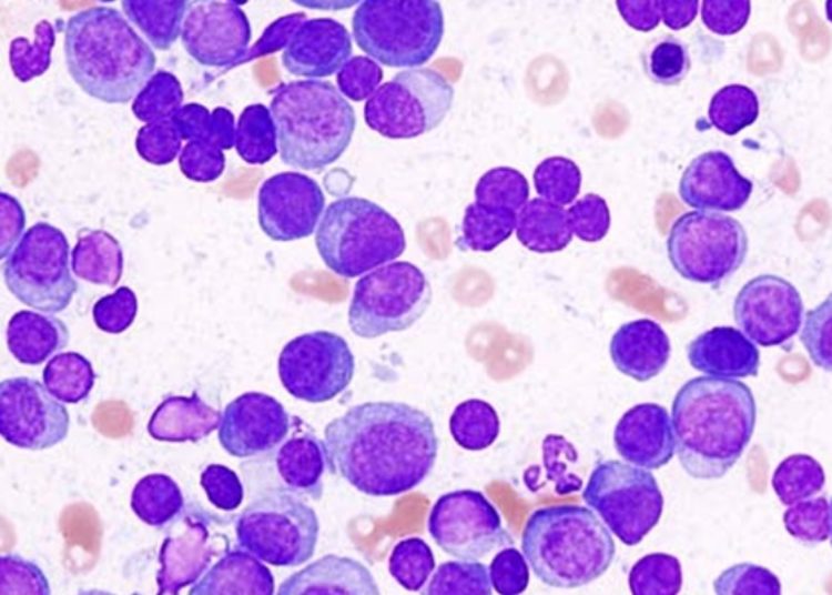 The STORM trial: treatment refractory multiple myeloma patients experience response with selinexor