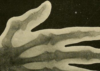 Quick Take: Dual-Energy Computed Tomography Detection of Cardiovascular Monosodium Urate Deposits in Patients With Gout