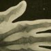Quick Take: Dual-Energy Computed Tomography Detection of Cardiovascular Monosodium Urate Deposits in Patients With Gout