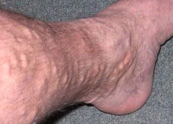 The CLASS trial: laser ablation and surgery improve quality-of-life for varicose vein patients compared to sclerotherapy