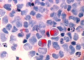 Quick Take: Factors associated with successful discontinuation of immune suppression after allogenic hematopoietic cell transplantation