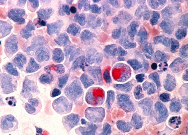 Quick Take: Factors associated with successful discontinuation of immune suppression after allogenic hematopoietic cell transplantation