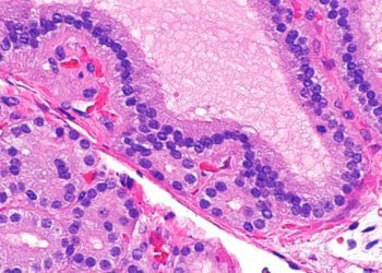 Teprotumumab may significantly improve outcomes in patients with active thyroid eye disease