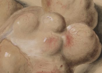 Elagolix with add-back hormone therapy effective in reducing fibroid-associated menstrual bleeding