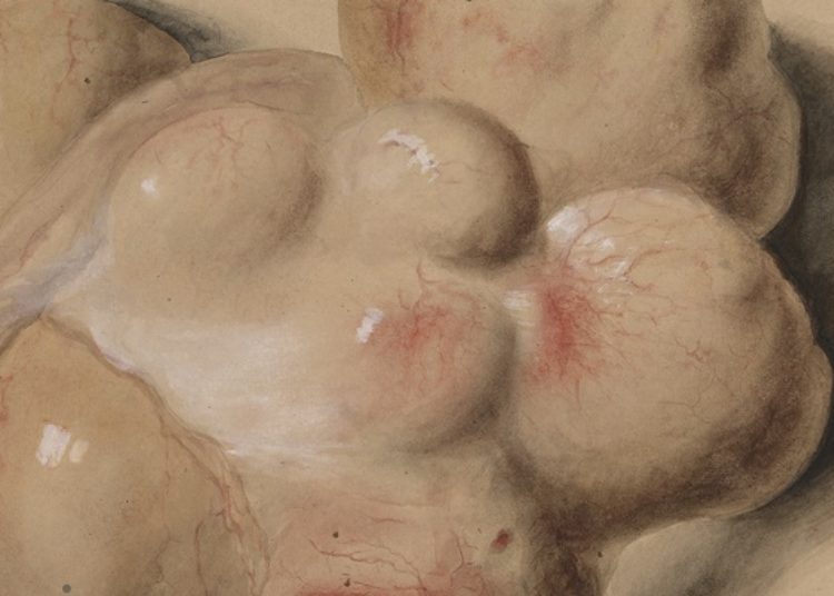 Elagolix with add-back hormone therapy effective in reducing fibroid-associated menstrual bleeding