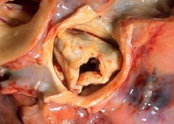 Rivaroxaban after TAVR linked with increased risk of adverse events compared to antiplatelet therapy