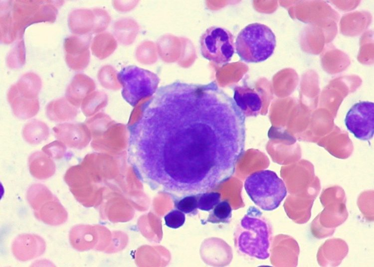 Luspatercept in Patients with Lower-Risk Myelodysplastic Syndromes 
