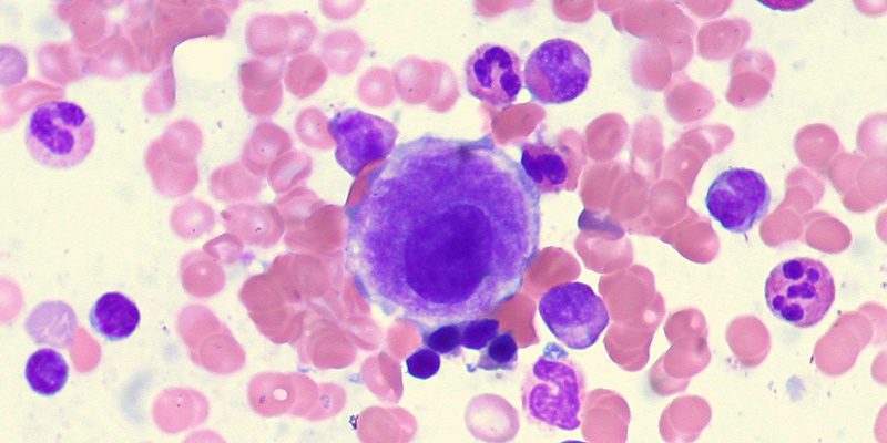 myelodysplastic