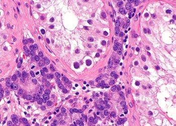 Testosterone replacement in male cancer survivors helps improve body composition