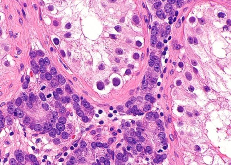 Testosterone replacement in male cancer survivors helps improve body composition
