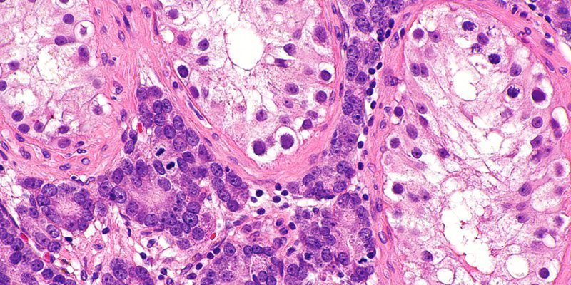 Testis_with_prostate_carcinoma_--_high_mag