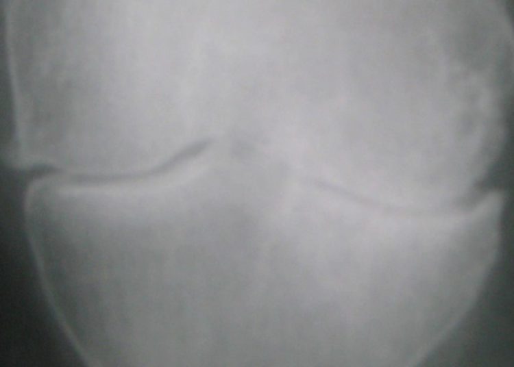 Physical therapy reduces pain in adults with knee osteoarthritis