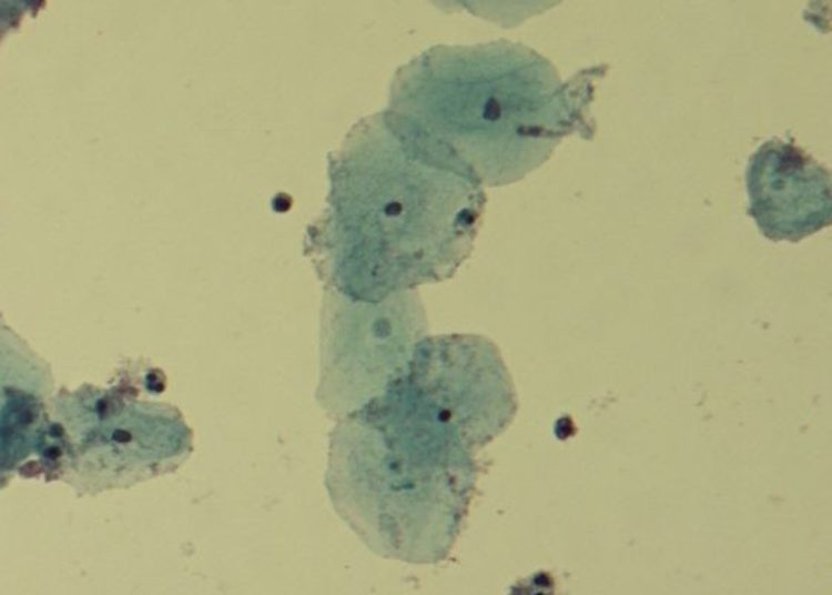 Biotherapeutic Lactin-V reduces incidence of bacterial vaginosis recurrence
