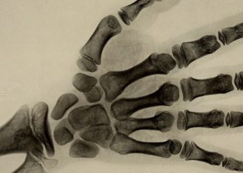 Clinical report outlines health supervision recommendations for patients with achondroplasia