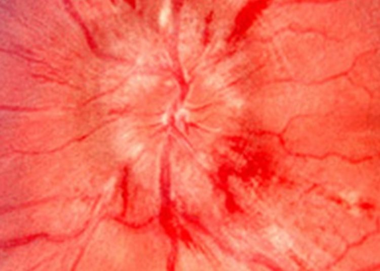 Artificial-intelligence, deep-learning algorithm identifies papilledema from fundus photographs