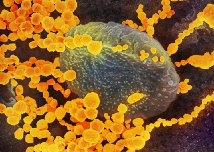 CD45 T cell and macrophage infiltration characteristic of COVID-19 related lung injury