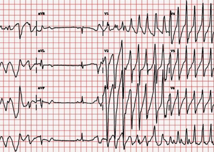 Risk of QTc prolongation with hydroxychloroquine therapy
