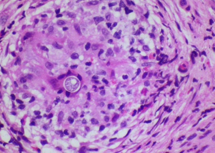 Interferon-γ and dupilumab effectively treat disseminated coccidioidomycosis infection