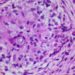 Interferon-γ and dupilumab effectively treat disseminated coccidioidomycosis infection