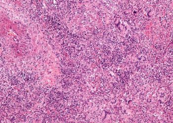 Long-term use of rituximab associated with lower rates of AAV relapse