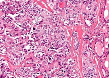 Selpercatinib may provide an effective response against RET-mutated thyroid cancer