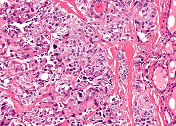 Selpercatinib may provide an effective response against RET-mutated thyroid cancer