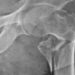 Bisphosphonate use and risk of atypical femur fractures