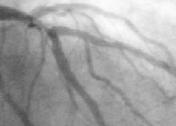 Colchicine may lower the risk of cardiovascular events in patients with coronary disease