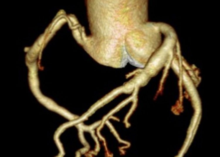 SARS-CoV-2 is associated with higher incidence of Kawasaki disease in children