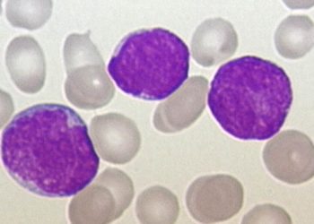 Dasatinib and blinatumomab treatment for acute lymphoblastic leukemia