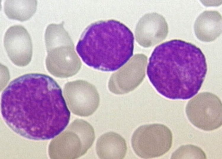 Dasatinib and blinatumomab treatment for acute lymphoblastic leukemia