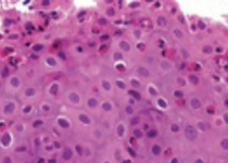 Lirentelimab may be effective for treatment of eosinophilic gastrointestinal disease