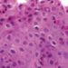 Lirentelimab may be effective for treatment of eosinophilic gastrointestinal disease