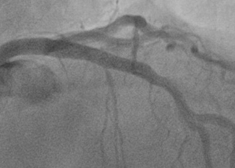 Drug-coated balloons are noninferior to drug-eluting stents for treatment of small vessel coronary artery disease