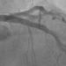 Drug-coated balloons are noninferior to drug-eluting stents for treatment of small vessel coronary artery disease
