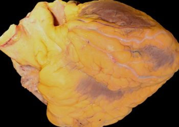 Rilonacept may lower pericarditis recurrence in patients with relapsing pericarditis