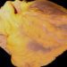 Rilonacept may lower pericarditis recurrence in patients with relapsing pericarditis