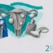 Fibroids collage: a uterus drawing with a few smooth round fibroids, a hot water bottle, an ultrasound probe and tulips