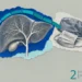 Bile duct cancer collage: an engraved liver with a branching bile duct tree and gallbladder beside a surgical cap and mask